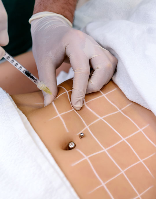 Injection Lipolysis Clinic in Banjara hills, Hyderabad