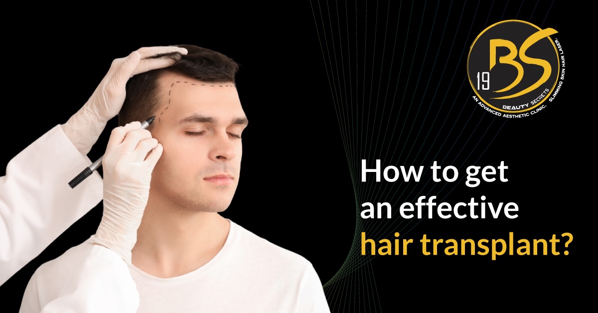 How to get an effective hair transplant